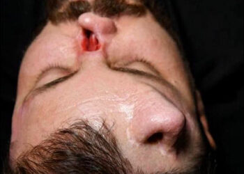 The patient undergoing nasal reconstruction, Sulaimani, Iraqi Kurdistan, July 2026, Sulaimani, Iraqi Kurdistan July 2026. Photo: Dr. Diyar Abdulwahid, a plastic and cosmetic surgery specialist/FB