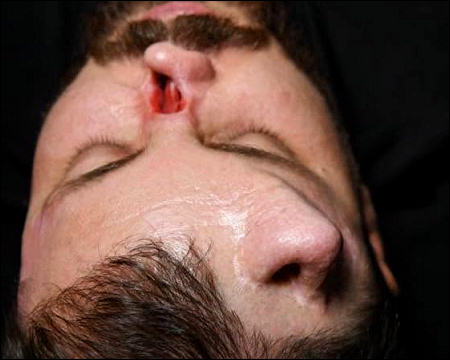 Kurdish doctors use forehead tissue to rebuild workers nose