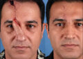 Prefabricated forehead flap nose cosmetic surgery 2026 iKurd net ai