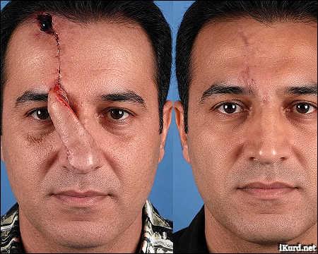 Kurdish doctors use forehead tissue to rebuild workers nose